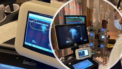 WaveBase technology was used in the development of AlveolAI's lung ultrasound B-line classification tool, shown here correctly identifying hydrostatic pulmonary edema (code: Smooth) at the bedside. Image courtesy of WaveBase.