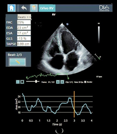 DiA's new AI-based ultrasound analysis tool LVivo RV. Image courtesy of DiA.
