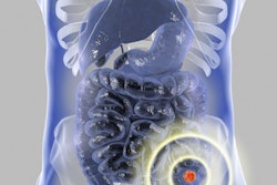 2021 03 22 20 32 6448 Colon Cancer 400