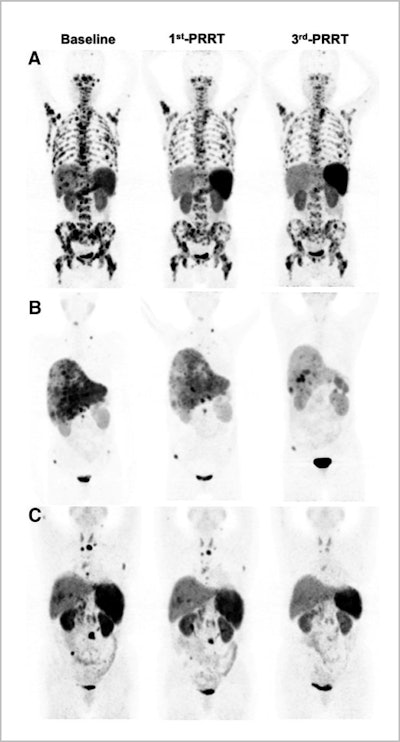 Representative images of partial remission in group A (A), group B (B), and group C (C). Image created by Qingxing Liu and Zhaohui Zhu/Peking Union Medical College Hospital, Beijing, and courtesy of JNM.