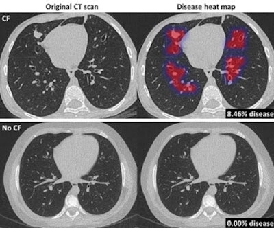 Original CT scan (left) and overlay (heat map; right) of disease areas in the lungs of a CF patient and healthy control, determined in several seconds by Thirona's new Pragma-AI software. Image courtesy of Thirona.