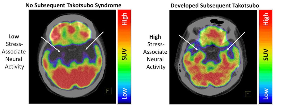 PET/CT shows link between stress and fatal heart condition 