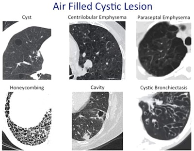 Various entities cause air-filled cystic lesions which need differentiation on CT. Courtesy of Dr. Peter Beddy.