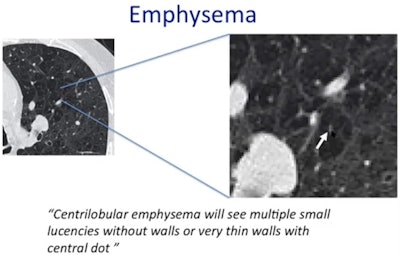Centrilobular emphysema has no or very thin walls and a central dot. Courtesy of Prof. Peter Beddy.
