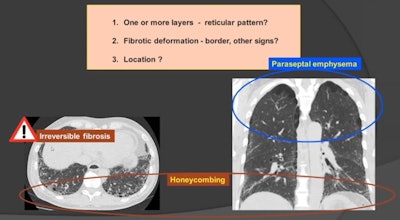 Location is the key when it comes to differentiating honeycombing from paraseptal emphysema. Courtesy of Prof. Johny Verschakelen.