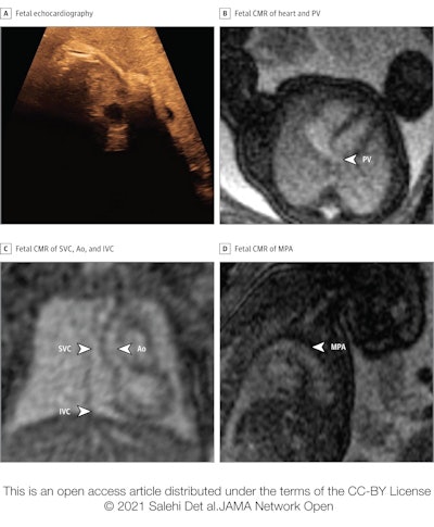 Basic assessment in a fetus with risk factors for cardiac malformation and a very poor acoustic window. The fetal heart and vessels were not visible at all during fetal echocardiography, due to mother having obesity (A). Fetal cardiovascular MRI showed normal-sized ventricles with normal systolic function and at least one normal pulmonary vein (PV) without obvious direct or indirect signs of aberrant pulmonary veins (B), superior venae cavae (SVC) and inferior venae cavae (IVC) and normal ascending aorta (Ao) (C), and normal main pulmonary artery (MPA) (D). This information ruled out major congenital heart disease, and delivery was planned at the hospital closest to the patient's home. A nonurgent postnatal echocardiography examination was performed before discharge, which showed a normal cardiovascular anatomy. Images and caption courtesy of JAMA Network Open.