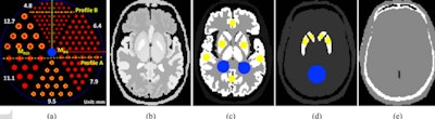 The 3D activity map (left) and the 3D reconstructed images for the brain perfusion study using the three configurations of the conventional scanner and a proposed SPECT eight-ring CZT scanner in AS-3 and AS-5 acquisition modes with 100 iterations and post-processed using a 3D Gaussian filter with a sigma of 1 pixel. Image courtesy of Youngho Seo, PhD.