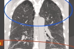2021 03 29 21 02 6304 2021 03 29 Lung Ct Capture6 400 Version2