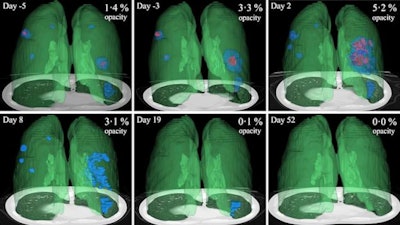 3D image visualizations show the evolution of COVID opacities over the course of the disease. Images courtesy of Nvidia.
