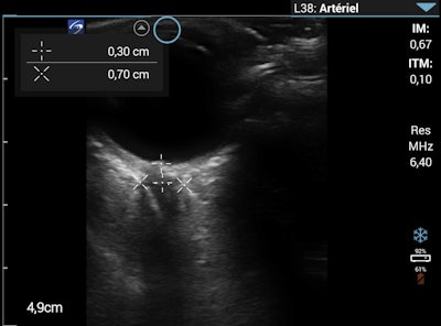Optic nerve sheath diameter measurement on the morning of day eight. Images courtesy of Wilderness and Environmental Medicine and Dr. Flavia Wipplinger, et al. Licensed under CC BY-NC-ND 4.0.