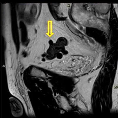 2021 03 22 16 47 5512 2021 03 22 Mri Insider Diverticular Disease 20210322161822