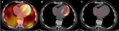 A 73-year-old male with chronic pericarditis and suspicion of cardiac sarcoidosis. The first exam was obtained with diet B, (a) nitrogen-13 ammonia and (b) F-18 FDG. Initially, this exam was interpreted as incomplete myocardial suppression and indeterminant cardiac sarcoidosis, agreed by the observer. A repeat F-18 FDG study with diet C (c), showed complete myocardial suppression with negative cardiac sarcoidosis, agreed by the observer and the report. Image courtesy of the Journal of Nuclear Medicine.