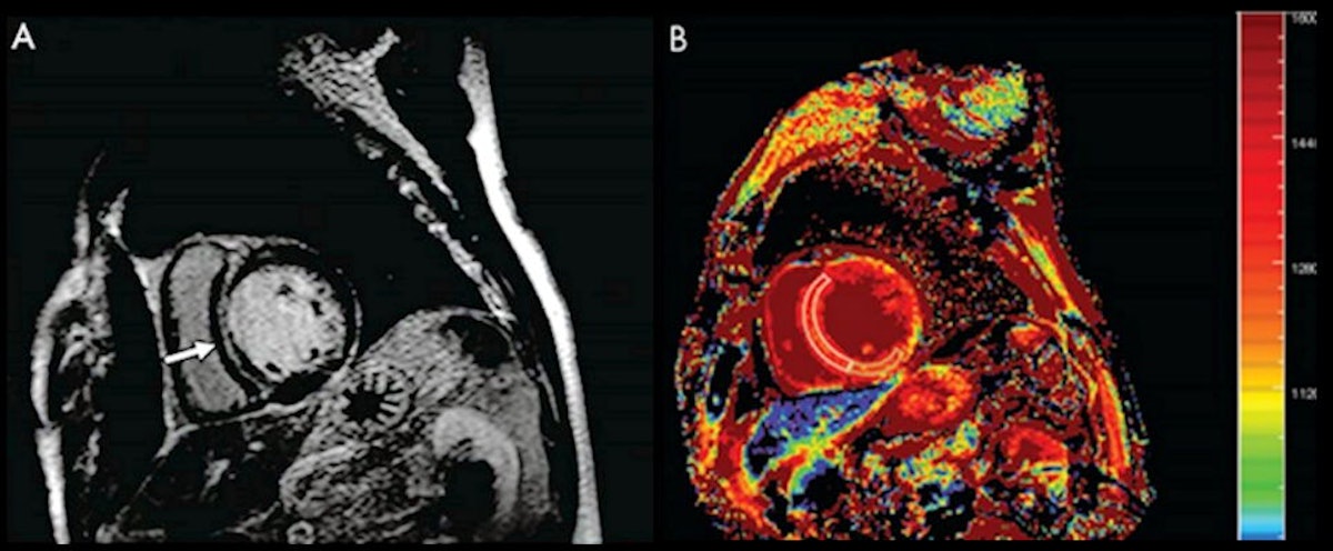 Myocardial Strain Evaluation with Cardiovascular MRI: Physics