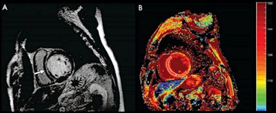 Imaging in a 60-year-old man with dilated cardiomyopathy and septal fibrosis. (A) Late gadolinium enhancement was found in the mid-wall of the interventricular septum (arrow). (B) Noncontrast-enhanced T1 mapping shows that the native T1 value of the septal region including late gadolinium enhancement (enclosed by a white line) is 1,382.2 msec, which is more than 1,349.4 msec ± 1.2 (standard deviation) above that of the minimum T1 value (enclosed by a green line, 1262.4 msec ± 62.0) in this patient. Images and caption courtesy of the RSNA.