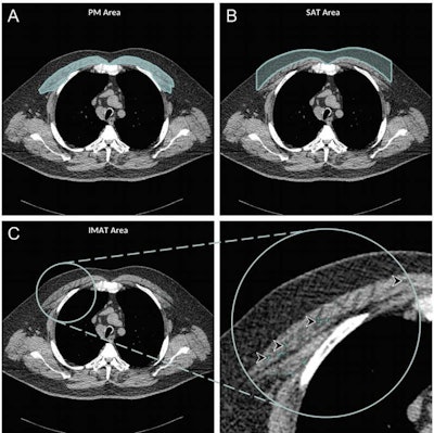 Axial chest CT examination in a 54-year-old participant. (A) On the axial noncontrast chest CT image, the pectoralis muscle (PM) area was segmented and measured in the section above the aortic arch. (B) The subcutaneous adipose tissue (SAT) area as the area between the pectoralis muscle and the skin surface on the same section was also measured and the attenuation of pixels in the subcutaneous adipose tissue area was used to determine the individualized threshold for the intermuscular adipose tissue. (C) The intermuscular adipose tissue within the pectoralis muscle was segmented as the areas with Hounsfield units below this threshold for the intermuscular adipose tissue (IMAT) (arrowheads). Images and caption courtesy of the RSNA.
