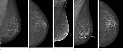 Images in a 72-year-old woman who was diagnosed with a 13-mm lymph node-negative invasive lobular carcinoma luminal B-line human epidermal growth factor receptor 2 breast cancer 18 months after a screening negative for cancer in the Malmö Breast Tomosynthesis Screening Trial. (a) Mediolateral oblique and (b) craniocaudal digital mammography images at screening. The slight retraction of the nipple was unchanged compared with previous digital mammography screening images. (c) Digital breast tomosynthesis at screening. Digital mammography of (d) mediolateral oblique and (e) craniocaudal views at diagnosis, small marker at lump location. Increased nipple retraction (arrow) and central mass (circle on d and e). Images and caption courtesy of Radiology.