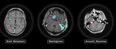 VBrain applies autocontouring to the three most common types of brain tumors: brain metastasis, meningioma, and acoustic neuroma. Image courtesy of Vysioneer.