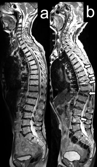 Sagittal T2-weighted MRI spine images in a 71-year-old man with mCRPC, at baseline (a), and two years after six cycles of radium-223 (b). Follow-up images show multiple nonmalignant endplate vertebral fractures at T7, T8, T9, T10, T12, and L4 (white arrows) with significant vertebral collapse at T10 and T12. Images courtesy of Clinical Genitourinary Cancer and Dr. Chris Parker, et al. Licensed under CC BY-NC-ND 4.0.