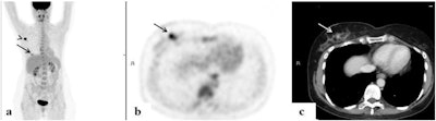 FDG-avid multifocal breast lesions. An 84-year-old woman with a multifocal cancer in the left breast and multiple bone FDG-avid metastatic lesions. FDG-PET/CT: maximum intensity projection (MIP) (a), a representative PET (b), and CT axial slices (c). Image courtesy of Surgical Oncology.