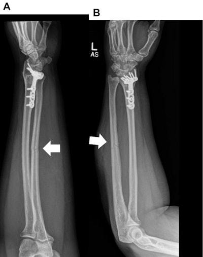 A 42-year-old woman with a history of “hit by boyfriend.” (A) Frontal and (B) lateral radiographs of the left forearm show a nondisplaced fracture of the mid-diaphysis of the ulna (wide bold arrows). There is an old healed fracture of the distal radius with hardware. Images courtesy of the Journal of the American College of Radiology.