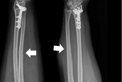 2021 04 07 19 24 6029 2021 04 07 Ulnar Fracture 20210407195445