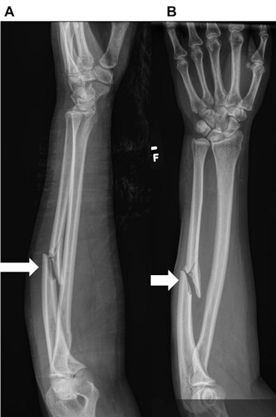 A 34-year-old woman with a history of motor vehicle collision. (A) Lateral and (B) frontal radiographs of the left forearm show a comminuted mildly displaced fracture of the mid-diaphysis of the left ulna (wide bold arrows).
