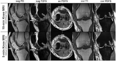 MRI scans in a 28-year-old man with a left knee injury from playing soccer. The corresponding noncontrast axial, sagittal, and coronal MRI scans of the 10-minute parallel imaging-accelerated knee MRI protocol (upper row) and five-minute simultaneous multislice- and parallel-accelerated knee MRI protocol (lower row) were obtained at 1.5-tesla field strength. Sagittal proton density-weighted (sag PD) and sagittal T2-weighted fat-suppressed (sag T2FS) MRI scans demonstrate a tear of the anterior cruciate ligament (black arrows) and a patella tendon tear (white arrows). Axial proton density-weighted fat-suppressed (ax PDFS) MRI scans redemonstrate the patella tendon tear (black arrows) and a tear of the medial collateral ligament (gray arrows). Coronal T1-weighted (cor T1) MRI scans demonstrate a bone contusion of the lateral femoral condyle with small, nondisplaced subchondral fracture (arrows). Coronal proton density-weighted fat-suppressed (cor PDFS) MRI scans redemonstrate the medial collateral ligament tear (short black arrows), a tear of the lateral meniscus (white arrows), and subchondral bone marrow edema pattern (long black arrows). Image courtesy of Radiology.