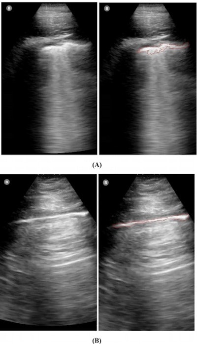 Examples of lung ultrasound images demonstrating the semiautomated detection method of pleural lines. The upper panel (A) shows a confirmed COVID-19 case with pleural thickening and irregularity. Right panel A shows pleural line detected with the semiautomated segmentation. The lower panel (B) shows an example of a normal case where the pleural line is outlined by semiautomated segmentation. Images and caption courtesy of the Journal of the American College of Emergency Physicians.