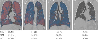 Visualization of lung involvement using attenuation difference maps and emphysema. (A) Image in a 66-year-old man with a 35-pack-year smoking history (Global Initiative for Chronic Obstructive Lung Disease [GOLD] stage 4, forced expiratory volume in 1 second [FEV1] = 23.8% predicted; FEV1/forced vital capacity [FVC] ratio = 0.32). (B) Image in a 61-year-old man with a 40-pack-year smoking history (GOLD stage 4, FEV1 = 12.9% predicted, FEV1/FVC ratio = 0.29). (C) Image in a 78-year-old man with a 65.8-pack-year smoking history and chronic bronchitis (GOLD stage 2, FEV1 = 59.6% predicted, FEV1/FVC ratio = 0.47). (D) Image in a 48-year-old man with a 26-pack-year smoking history (GOLD stage 0, FEV1 = 92.9% predicted, FEV1/FVC ratio = 0.82). %AT = percentage air trapping, %EM = percentage emphysema, %TLI = percentage total lung involvement. Images and caption courtesy of the RSNA.
