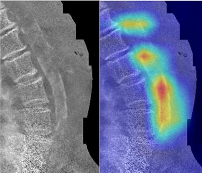 Example dual-energy vertebral fracture assessment images and their corresponding convolutional neural network activation maps. Areas colored toward the red end of the spectrum are of greater significance to the CNN. Above: Human-labeled abdominal aortic calcification score was 20; CNN-predicted score was 21.1. Below: Human-labeled abdominal aortic calcification score was 5; CNN-predicted score was 5.6. Images courtesy of Bone.
