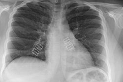 2021 04 12 20 58 1884 2021 04 12 Tg Cxr 20210412204048
