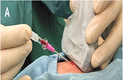 Ultrasound guidance proved to be superior to traditional landmark guidance in a randomized trial conducted by researchers at Temple University. Image courtesy of Dr. Ryan Gibbons.