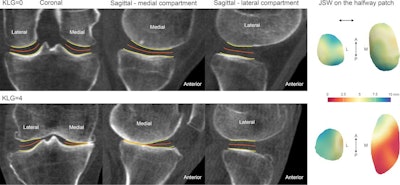 Articular bone surfaces at the femur and tibia from joint space mapping output (yellow) with the halfway surface (orange), alongside joint space width (JSW) displayed on the halfway patches (far right). This is shown for individuals with a radiographic Kellgren-Lawrence grade (KLG) of 0 (top row) or 4 (bottom row), demonstrating robust performance in the extremes of the disease. A = anterior, L = lateral, M = medial, P = posterior. Image and caption courtesy of the RSNA.