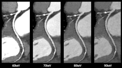 Spectral cardiovascular images produced by Canon Medical Systems' Aquilion One/Prism Edition CT with FDA-cleared deep learning software. Images courtesy of Canon Medical Systems.