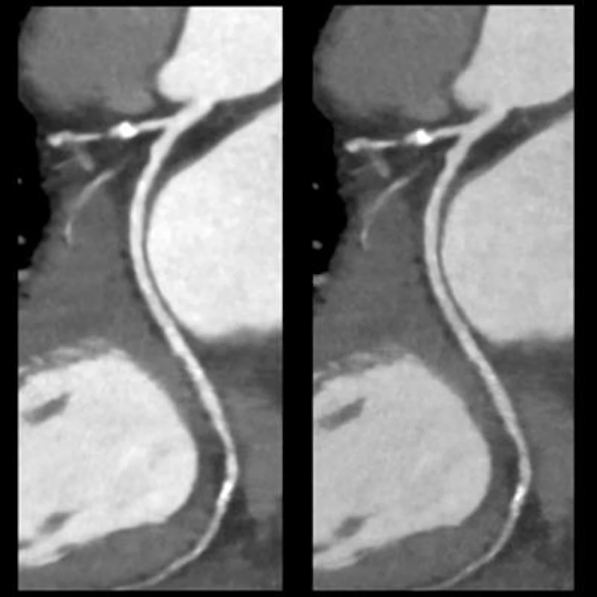 FDA clears Canon's spectral CT for cardiovascular applications | AuntMinnie