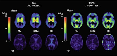 Image shows mean THK5317 and PK11195 nondisplaceable binding potential (BPND) for controls, rSRC and TBI patients, depicting tau and translocator protein (TSPO) expression, as well as corresponding standard deviation images. In symptomatic rSRC athletes, a voxel-wise t-test showed clusters of significantly increased THK5317 binding in the corpus callosum and subcortically including the medial temporal region and PK11195 binding in the medial temporal lobes. In TBI, elevated tau and TSPO binding was observed in the thalamus, temporal lobe white matter and midbrain. Significant group differences in total tau load were found between healthy controls and rSRC in subcortical gray matter (SRC 7.5 ± 0.9, controls 6.7 ± 0.5, p = 0.038), although not between TBI patients and controls. No significant differences in the number of voxels with THK5317 BPND > 0.5 or skewness in BPND distribution were found. Image courtesy of NeuroImage: Clinical.