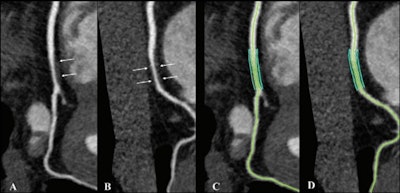 Noncalcified coronary plaque in an asymptomatic 52-year-old man living with HIV with a 10-year Framingham risk of 5%. Images show 256-section contrast-enhanced coronary CT angiography with electrocardiographic gating and curve reformat. (A, B) CT scan shows a smooth noncalcified plaque in the right coronary artery (arrows) with 70%-80% stenosis. (C, D) The right coronary artery plaque volume was 130 mm3 (green lines).
