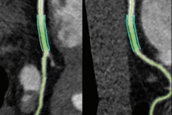2021 04 19 22 44 9184 2021 04 20 Ct Coronary Plaque Hiv Figure4 20210419225209