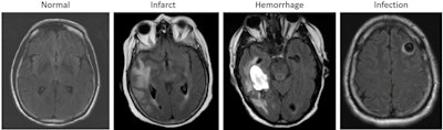 Examples of axial FLAIR sequences from studies within dataset A. From left to right: a patient with a 'likely normal' brain, a patient presenting an intraparenchymal hemorrhage within the right temporal lobe, a patient presenting an acute infarct of the inferior division of the right middle cerebral artery, and a patient with known neurocysticercosis presenting a rounded cystic lesion in the left middle frontal gyrus. Image and caption courtesy of RSNA.
