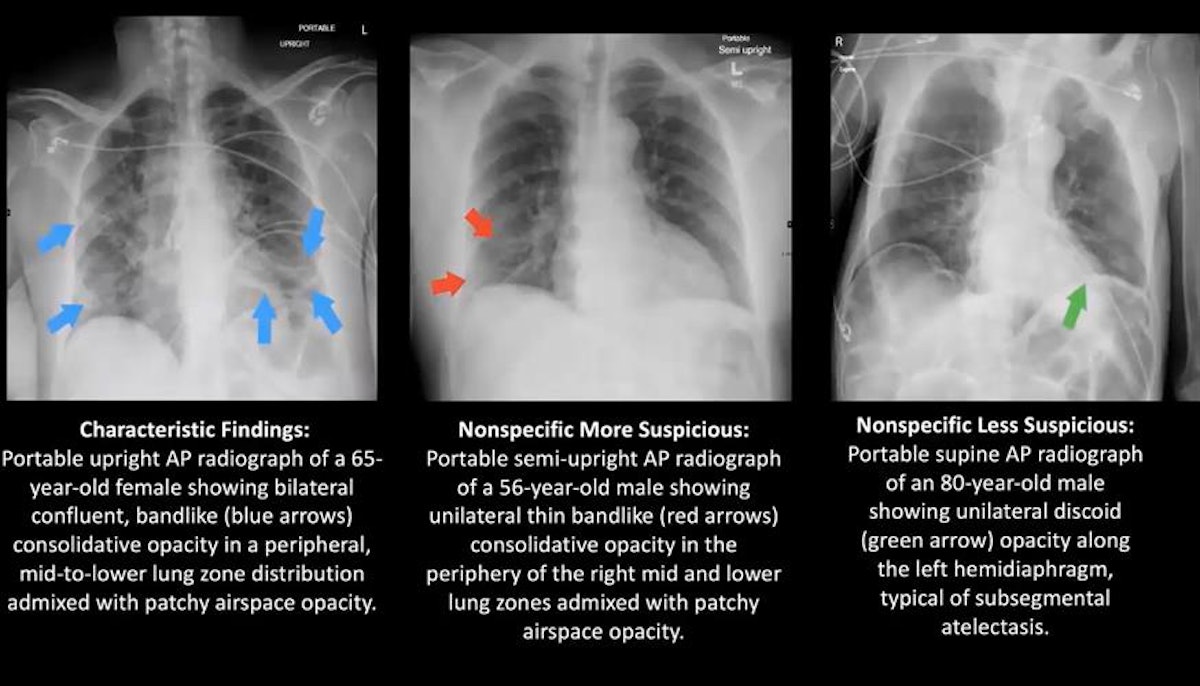abnormal chest x ray images