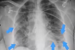 2021 04 22 18 10 5040 2021 04 23 Cxr Covid3 20210422185336