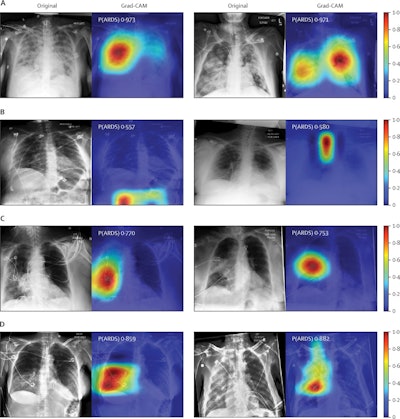 Chest radiographs were grouped based on CNN probabilities of ARDS and physician ARDS annotations; gradient-weighted class activation mapping (Grad-CAM) was then used to localize areas used by the CNN to identify ARDS within the radiographs. The heat map illustrates the importance of local areas within the image for classification. The importance value is scaled between 0 and 1 where a higher number indicates that the area is of higher importance for classifying the image as consistent with ARDS. (A) Chest radiographs annotated as ARDS by six of six physicians and assigned a high CNN probability. (B) Chest radiographs scored as consistent by six of six physicians but assigned a lower probability by the CNN. (C) Chest radiographs annotated as ARDS by zero of six physicians but assigned a high probability by the CNN. (D) Chest radiographs with disagreement among physicians (three of six physicians annotating ARDS) and assigned a high probability by the CNN. P(ARDS): probability that the chest radiograph is consistent with ARDS. Image courtesy of Lancet Digital Health.