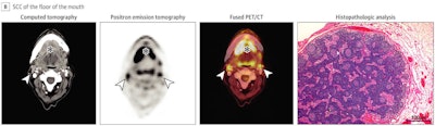 Images of a 59-year-old woman with SCC of the floor of the mouth (star). Both the CT and PET images depicted bilateral, enlarged/hypermetabolic lymph nodes that are suspicious for nodal metastases (arrowheads). However, histopathologic analysis revealed only inflammatory and reactive changes with prominent reactive secondary follicles of the lymph node. There was no evidence of cancer. Hematoxylin-eosin, original magnification ×20 in histopathologic analysis.