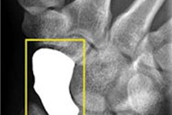 2021 04 27 23 37 4067 2021 04 28 Ai Wrist Fracture 20210427230942