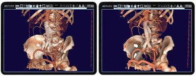 Using IMS' CloudVue viewer for mobile 3D with cinematic rendering, physicians can use both views to determine the procedure's efficacy. One can see the stent placement in both environments, and mobile 3D with cinematic rendering. The surgical team is using these images to determine the outcome of this patient's procedure. Image courtesy of IMS.