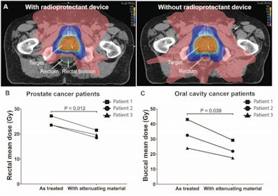 Dosimetric modeling of radioprotectant devices in patients. (A) Axial CT images of radiation plan of a prostate cancer patient with a radioprotectant device compared to without a radioprotectant device (as treated) showcasing the impact of the device on reducing radiation exposure to the rectum. Comparison of dosimetric plan with or without attenuating material in (B) prostate cancer patients (n = 3) and (C) oral cavity cancer patients (n = 3). Mean doses were calculated as the average of the dose to each voxel contained within the organ; voxels of 2 mm × 2 mm in X and Y, and 2.5 mm in the Z direction; p-value was determined by paired two-sample t test. Images and caption courtesy of Advanced Science and Dr. James Byrne, PhD, et al. Licensed under CC BY-SA 4.0.