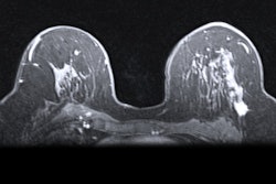 2019 07 22 20 17 2160 Mri Breast 400