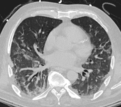 (Above) A CT image of a 64-year-old male who expired 3 days after the CT examination. (Below) Survival curves of the patient estimated by various predictors described in the paper. The median survival time estimated by the U-survival model was three days (red-dotted vertical line), which precisely predicted the actual survival time. The other predictors did not estimate survival time. Image and caption courtesy of Janne Näppi.