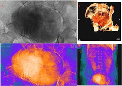 Abdominal area of the mummy: (A) x-ray; (B-D) CT.