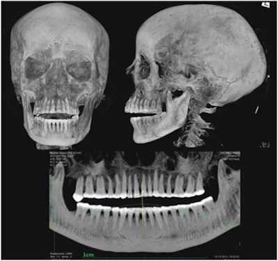 X-ray of the head and the pantomographic image of the teeth of the mummy.